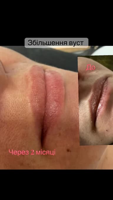 Збільшення вуст — Перманентний макіяж «Galina» у Козятині — фото 1