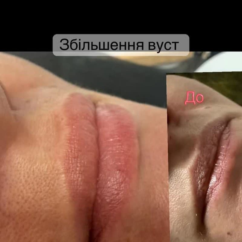 Збільшення вуст