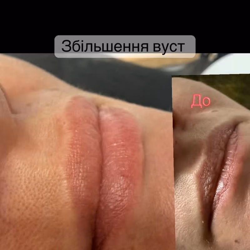 Збільшення вуст