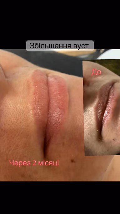 Збільшення вуст - Перманентний макіяж «Galina» у Козятині — фото 1